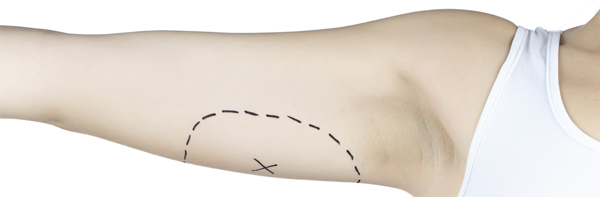 arm lift auckland plastic surgical centre